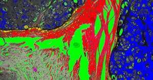 Hinalea - Spectral image of stained soft tissue cancer