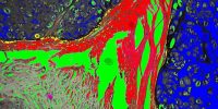 Hinalea - Spectral image of stained soft tissue cancer